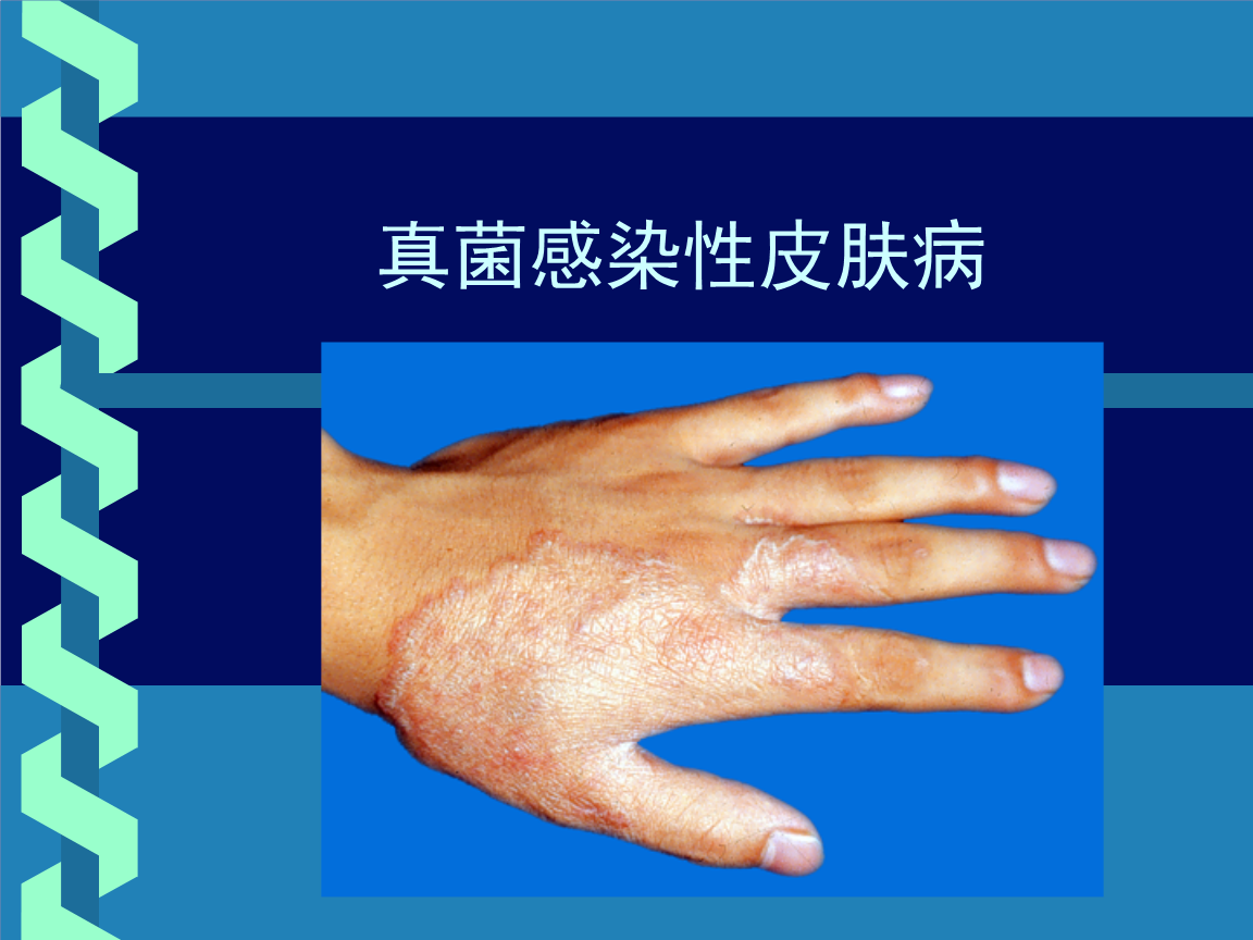 集团菌感染，一种不容忽视的疾病，集团菌感染，不容忽视的疾病威胁